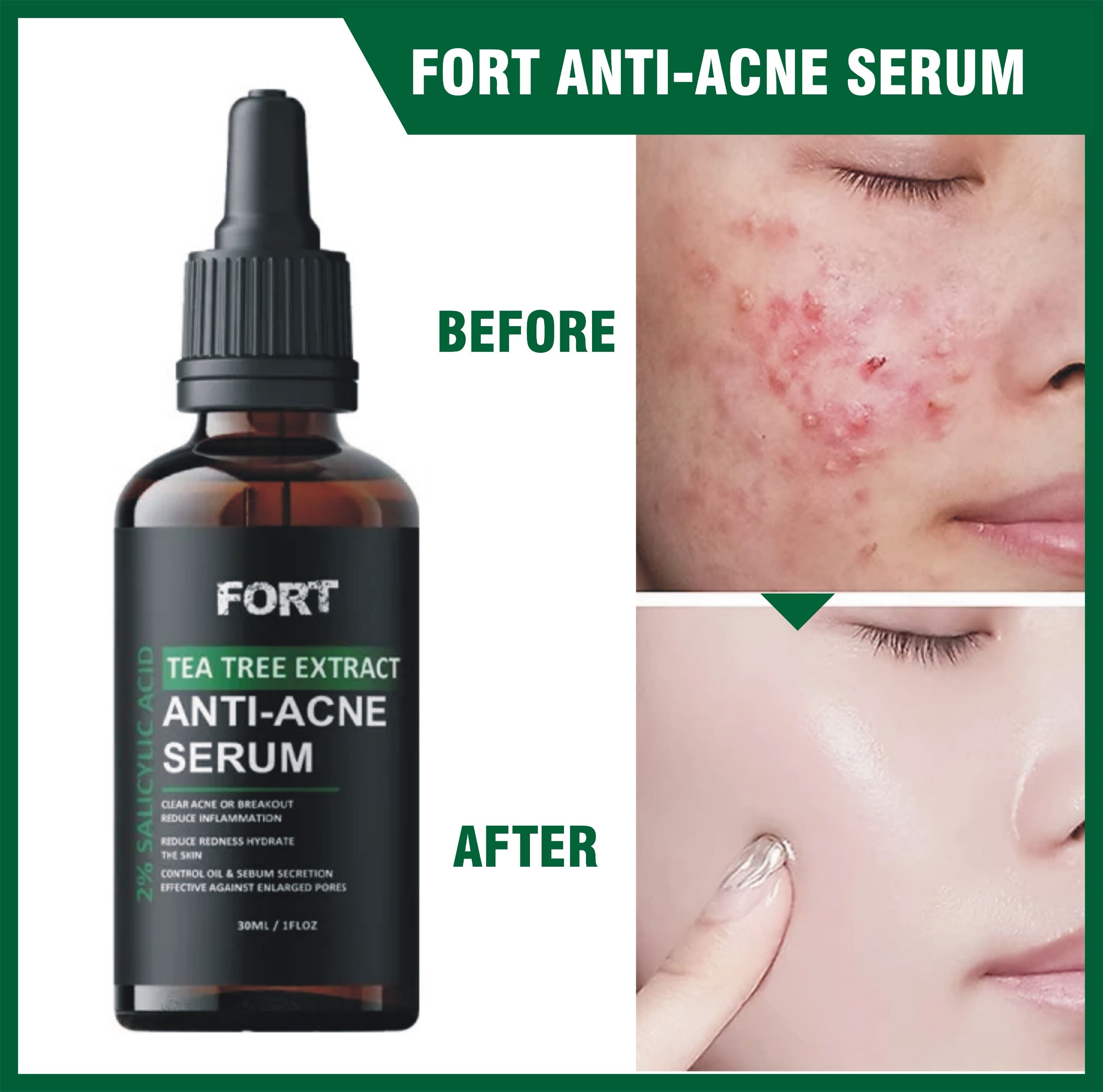 FORT Salicylic Acid Serum: Acne Treatment & Dark Spot Corrector for Radiant, Clear Skin (30ml)